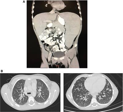 Case Report: Common variable immunodeficiency phenotype and granulomatous–lymphocytic interstitial lung disease with a novel SOCS1 variant